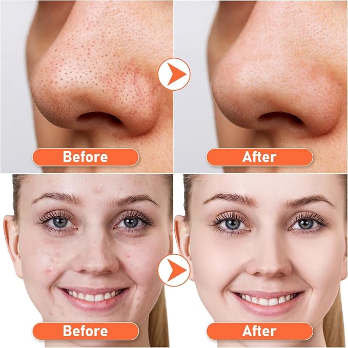 Removedor de puntos negros - Skinera