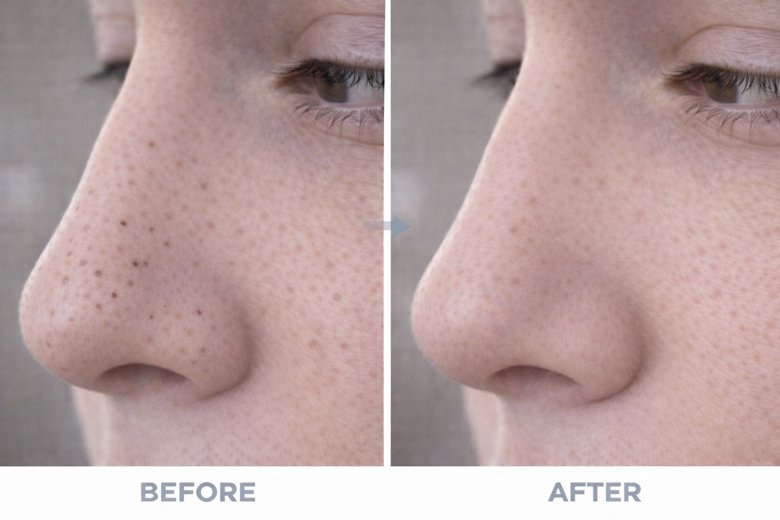 Removedor de puntos negros - Skinera